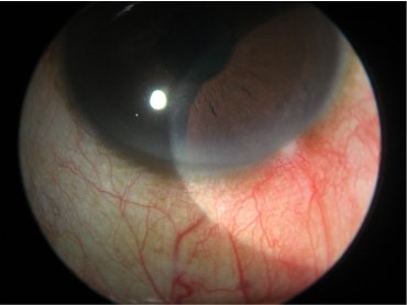 Myopia in Childhood